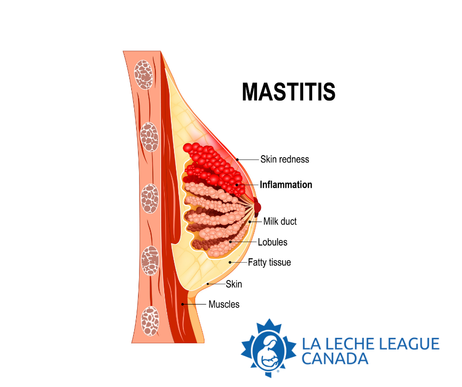 Mastitis a Matter of Inflammation La Leche League Canada